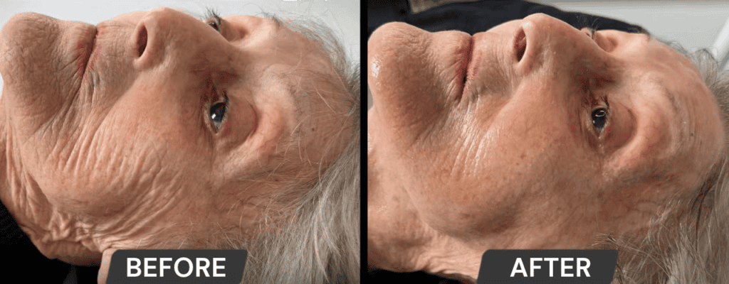 Before and after facial skin rejuvenation treatment for mature skin.
